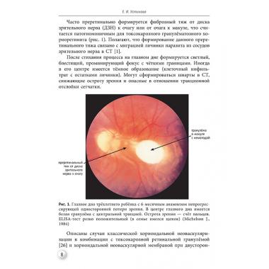О современных методиках выявления и лечения токсокароза глаз